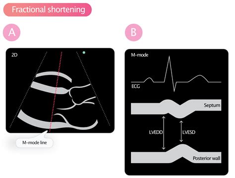 ejection fraction vs fractional shortening